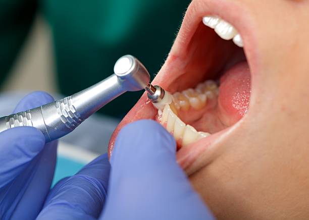 Dental Bonding in Palisades Park, NJ